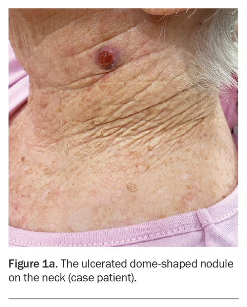 ‘I plucked a hair out of my mole’ – an enlarging ulcerated nodule